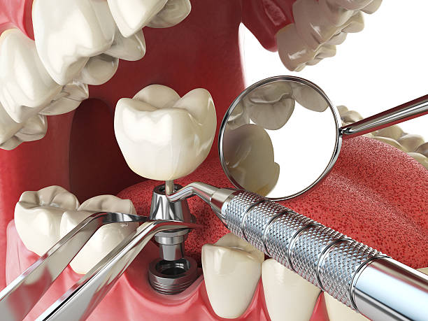Best Emergency Tooth Extraction in Jacksonville, TX