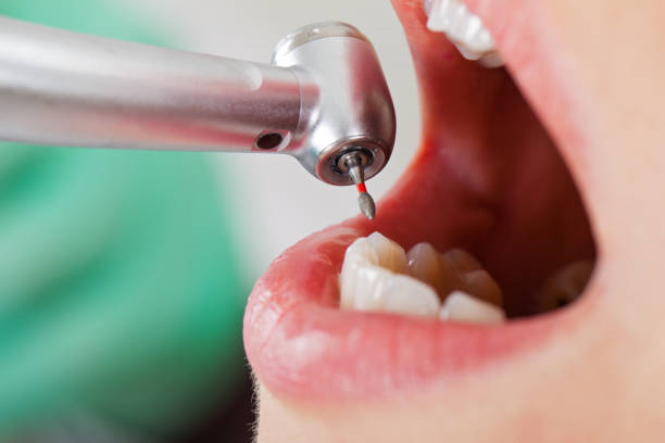 Best Emergency Dental Care for Broken or Chipped Teeth in Jacksonville, TX